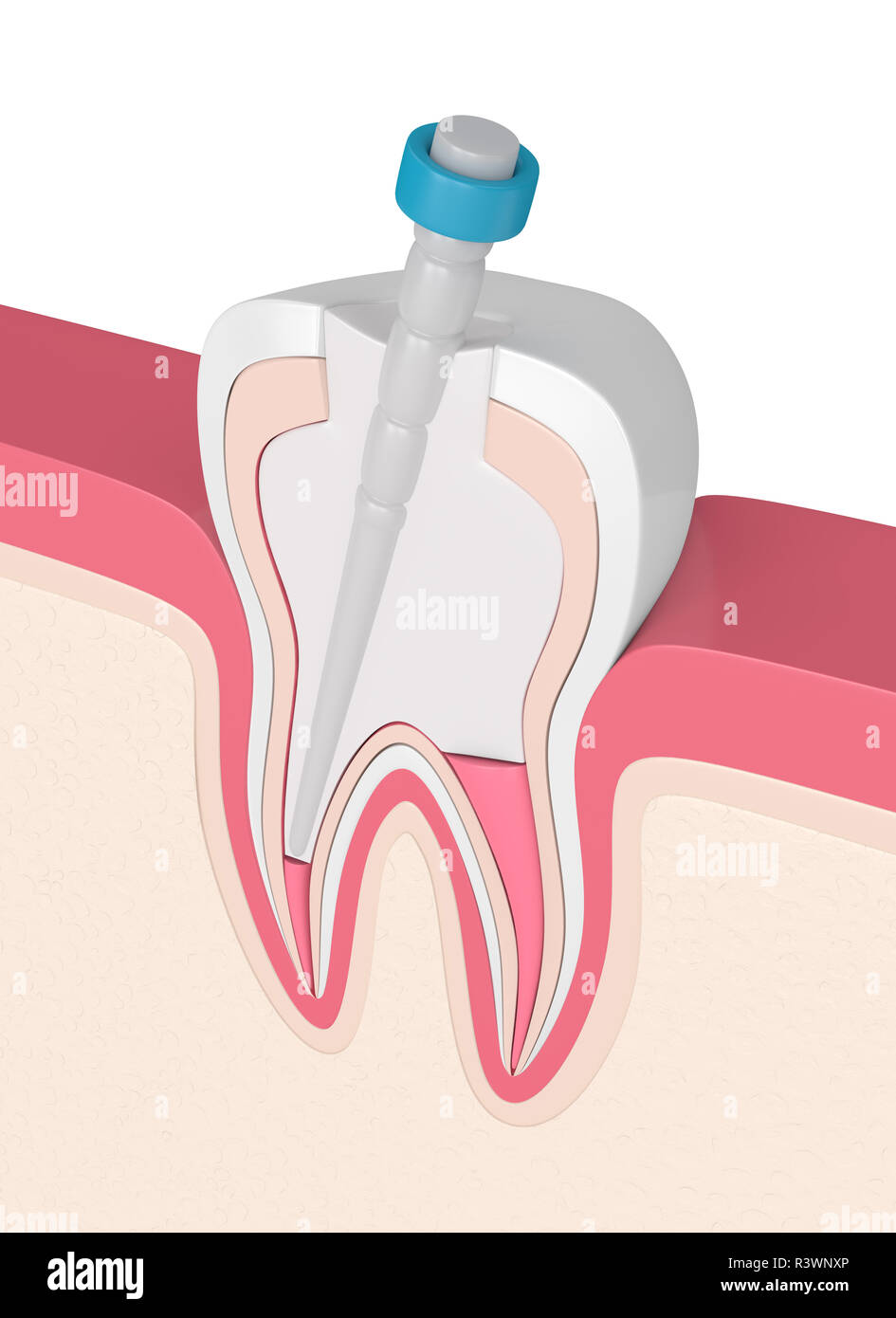 3d render of tooth with gutta percha, fiber post and filling in gums. Endodontic treatment concept Stock Photo