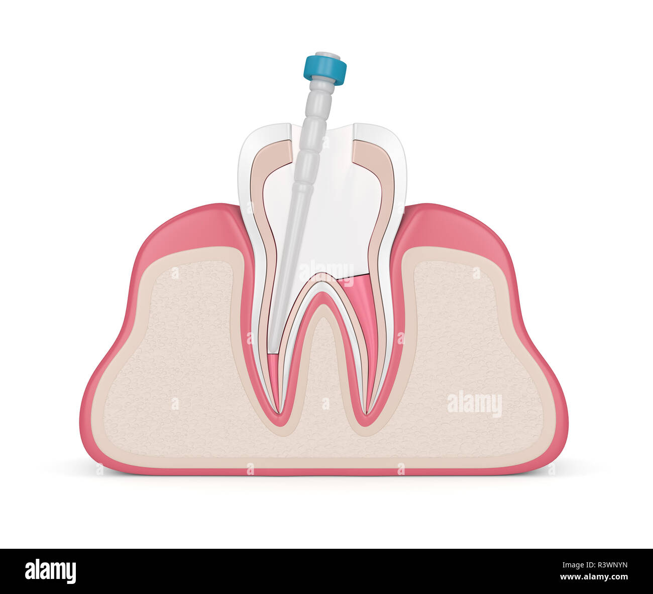 3d render of tooth with gutta percha, fiber post and filling in gums