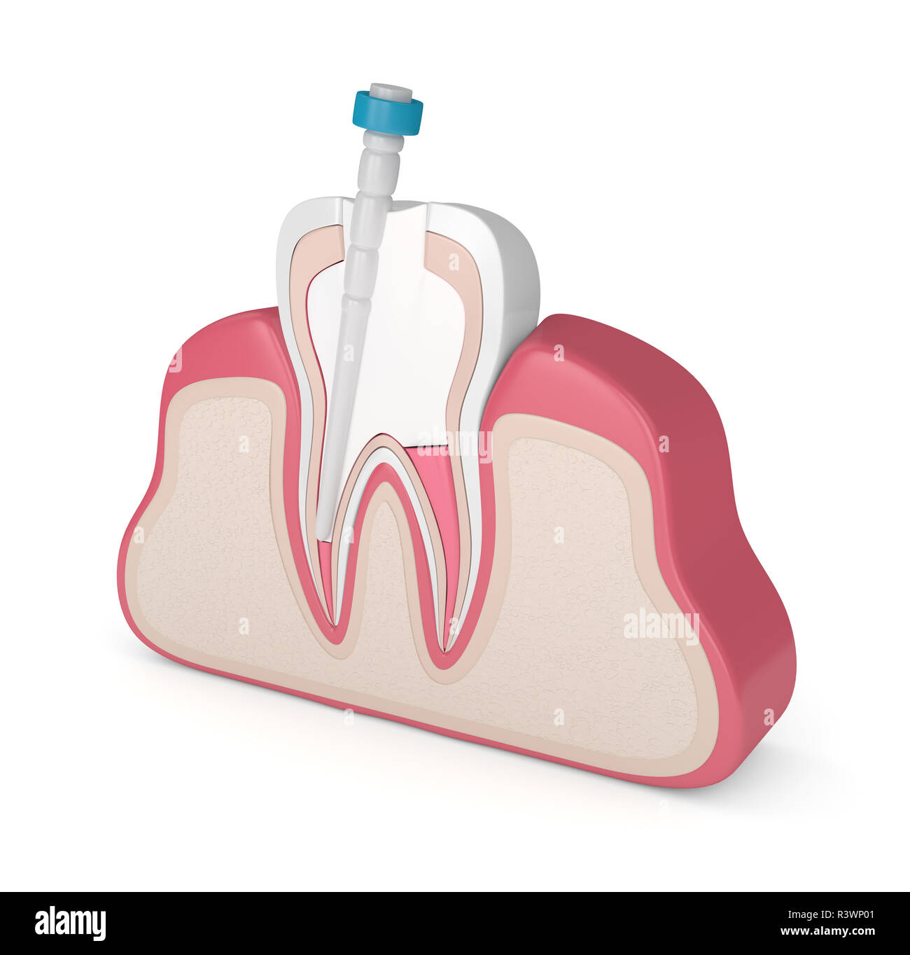 3d render of tooth with gutta percha, fiber post and filling in gums