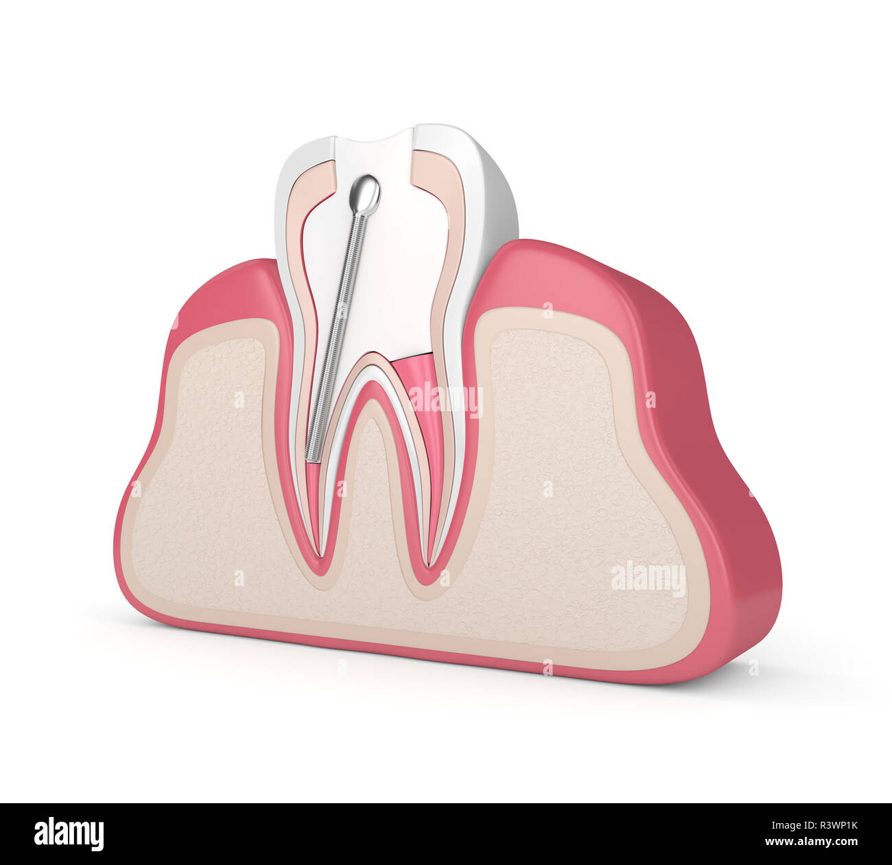 3d render of tooth with stainless steel dental post and filling in gums