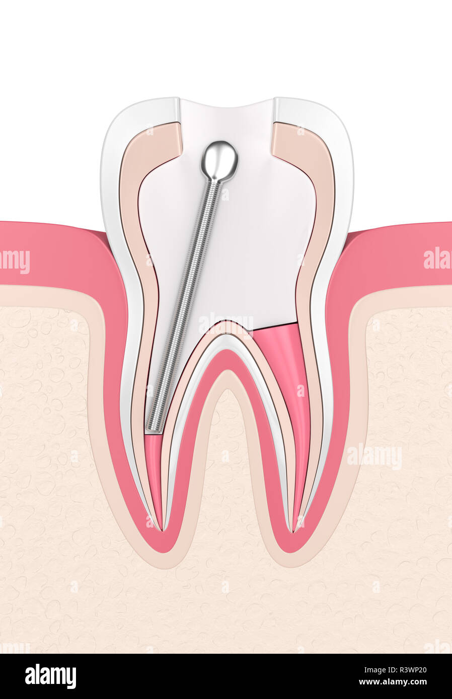 3d render of tooth with stainless steel dental post and filling in gums. Endodontic treatment concept Stock Photo