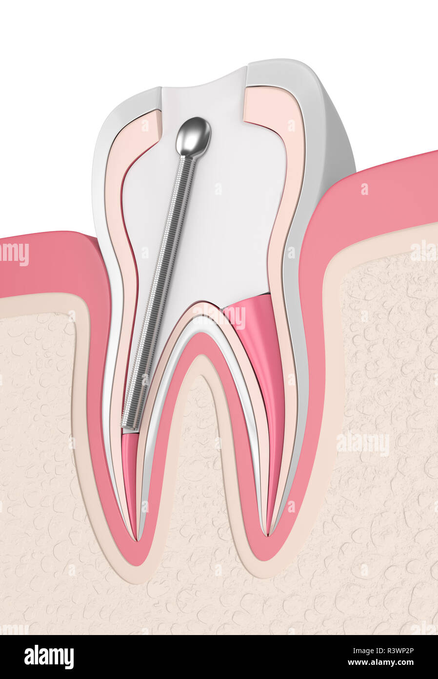 3d render of tooth with stainless steel dental post and filling in gums