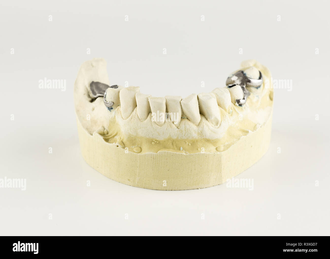 steel base of the clasp prosthesis on the gypsum model Stock Photo - Alamy