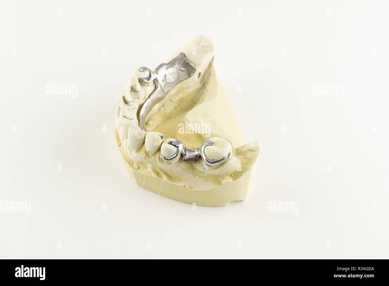 steel base of the clasp prosthesis on the gypsum model Stock Photo - Alamy