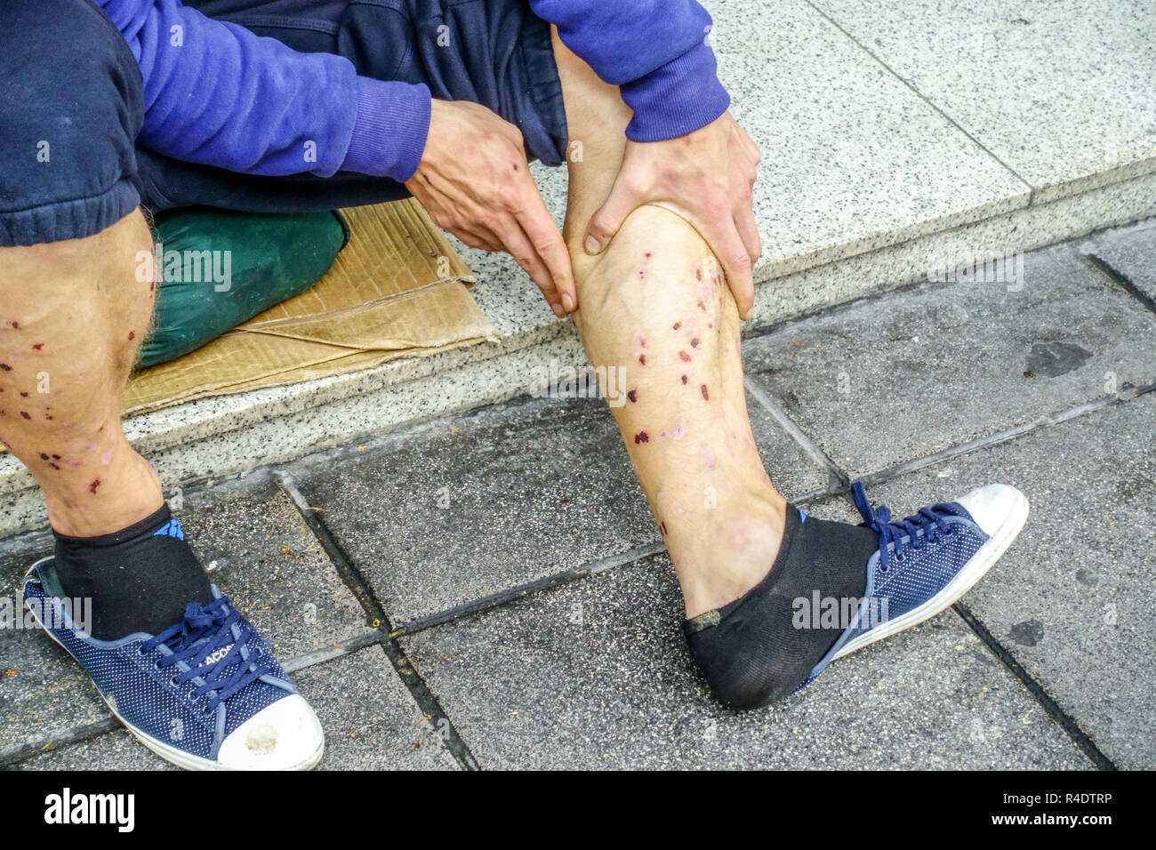 Drug addict, bloody scabs after injection on skin, legs unhealthy lifestyle Stock Photo