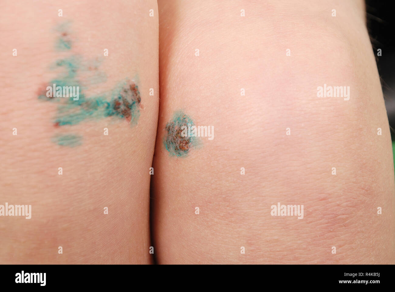 Scraped knee of a little girl. Injured leg with a healing wound. Stock Photo