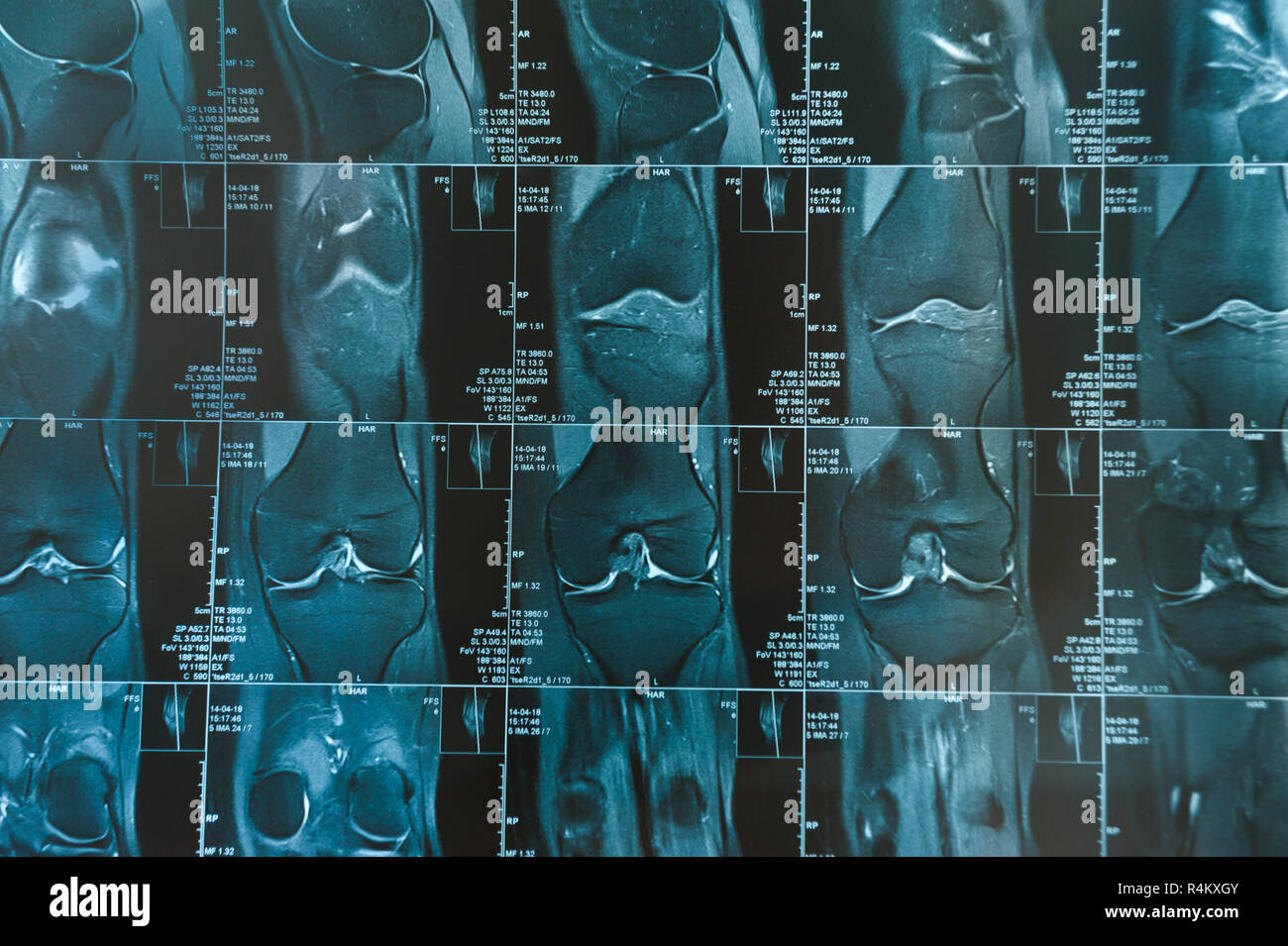 Magnetic resonance imaging shot of knee-joint closeup mri shot Stock Photo