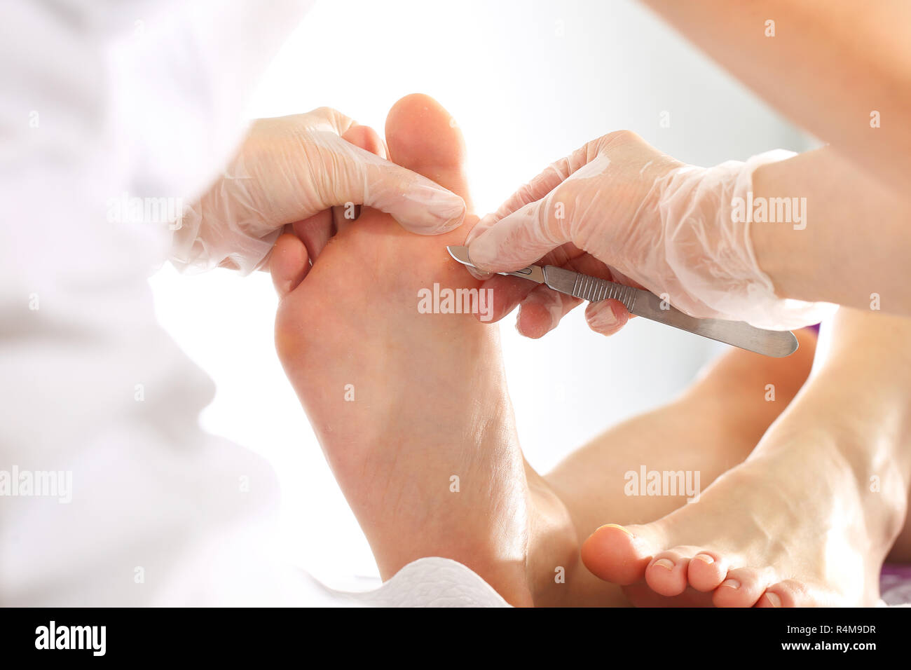 healthy feet. callus on the foot. imprint on the foot. the doctor