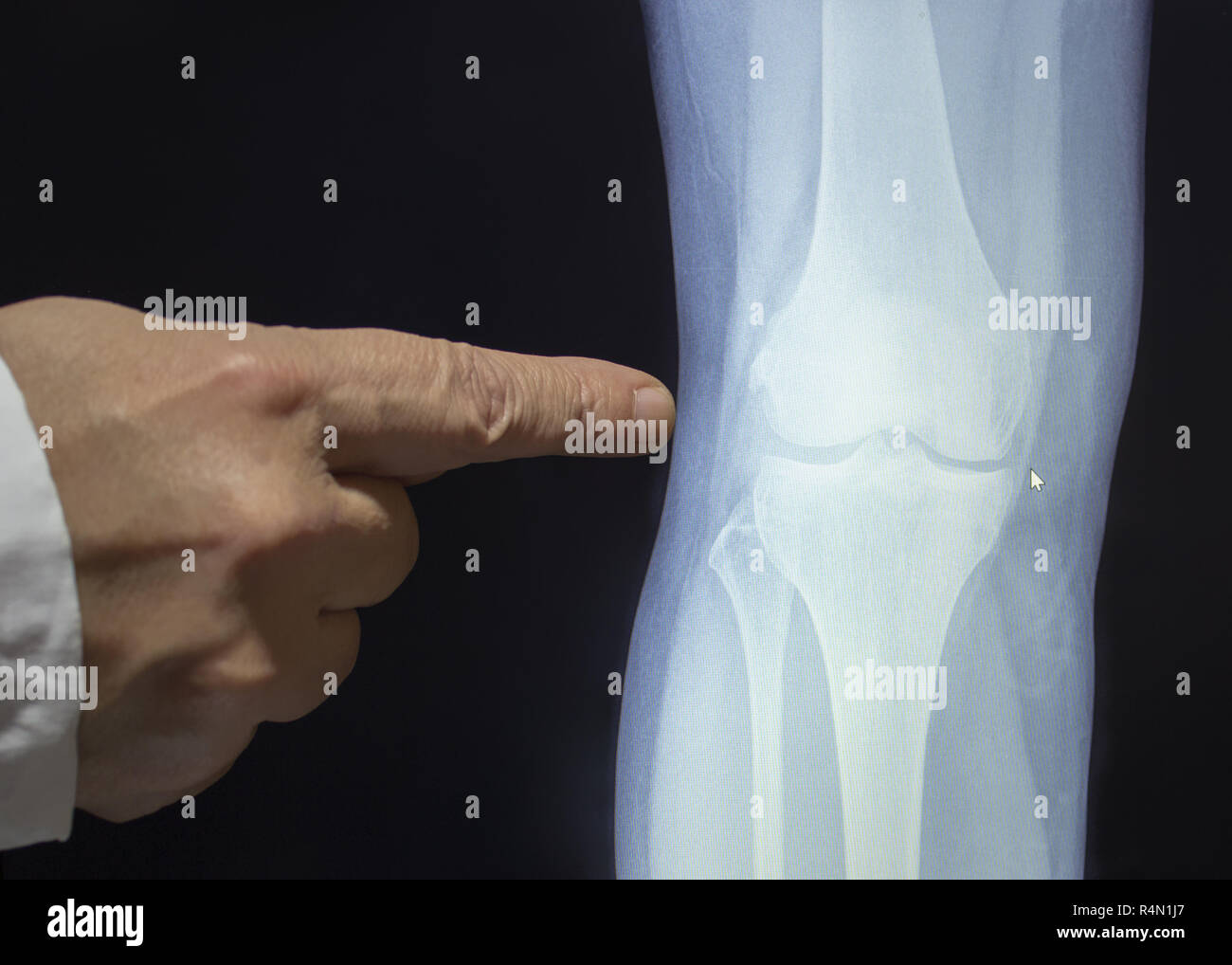 An xray of a knee with a hand of doctor witch pointing to a fracture Stock Photo