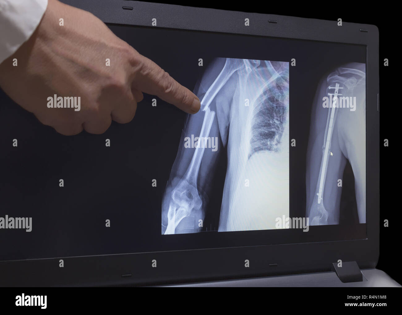 On the monitor screen is displayed an xray of fracture of a hand with the hand of a doctor pointing to a fracture. The second image on the screen is h Stock Photo