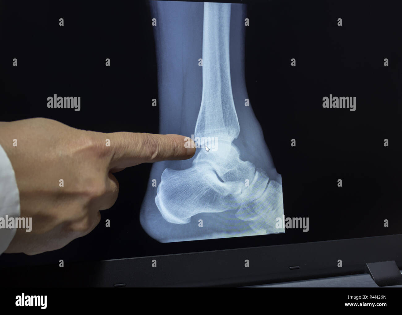An xray of a heel with a hand of doctor witch pointing to a fracture Stock Photo