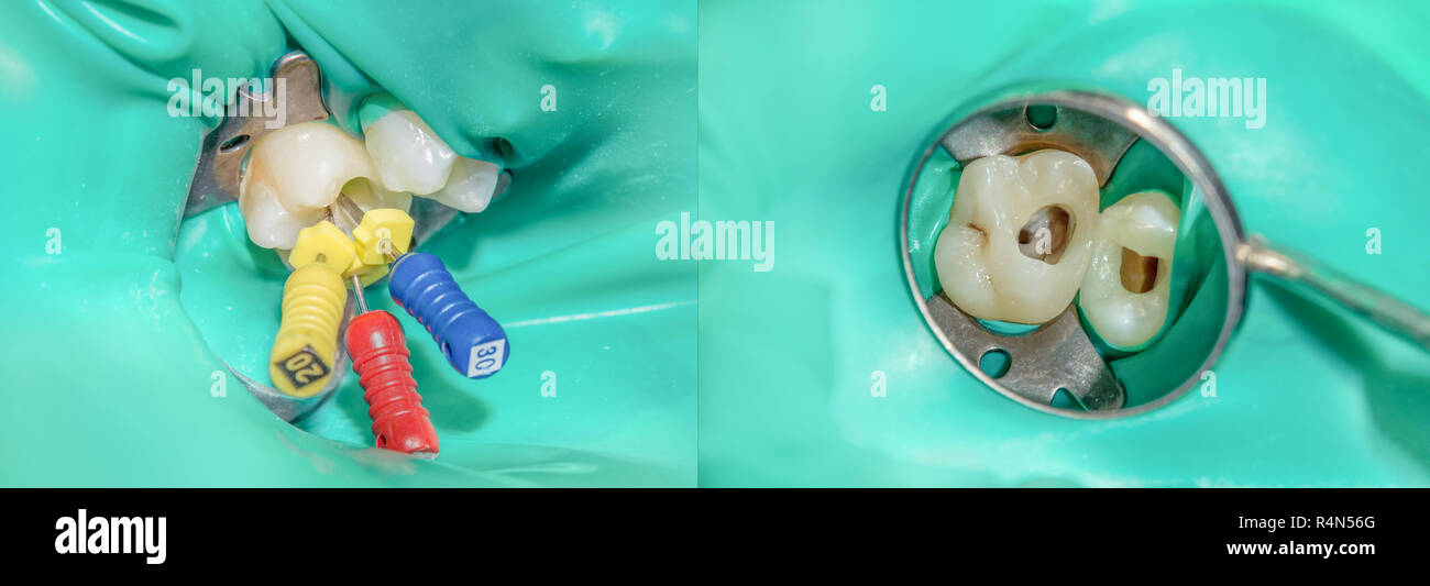 photo endodontic treatment of dental canals in the lower molar permanent tooth molar with