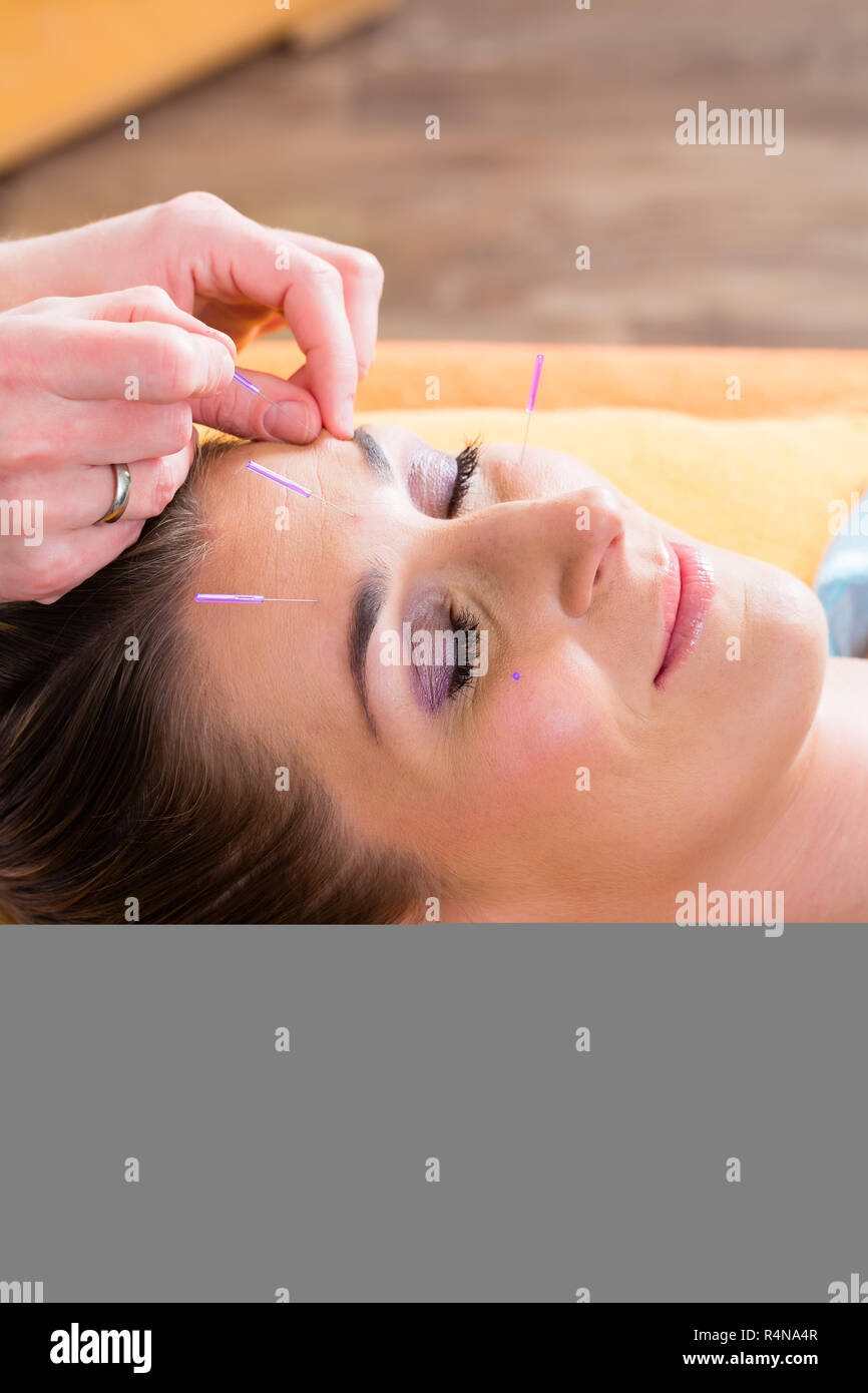 Therapist setting acupuncture needles Stock Photo Alamy