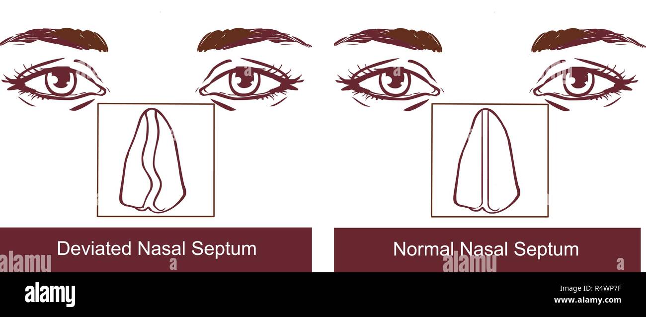 Nasal Septum Deviation Treatmen Stock Vector