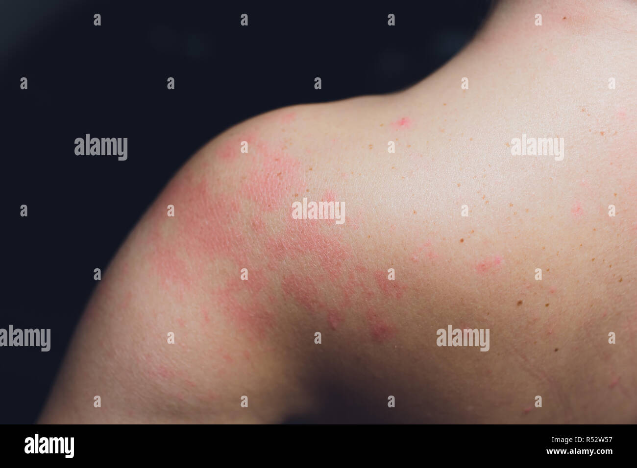 Close up Allergy rash, Around Back view of human with dermatitis ...