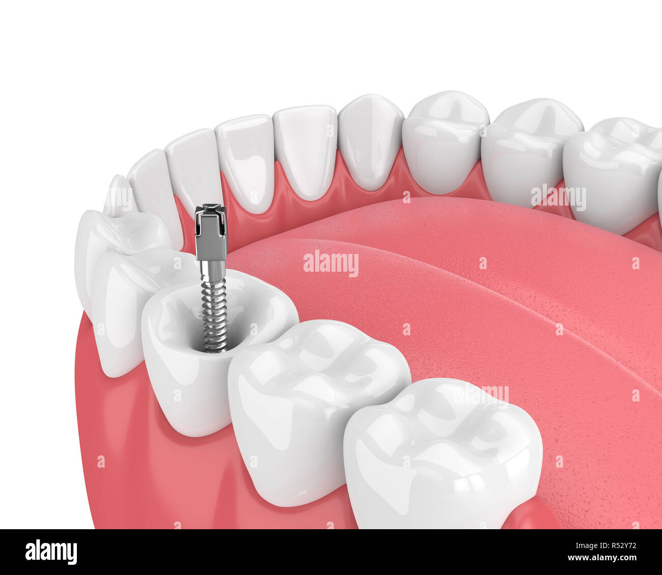 3d render of jaw with teeth and dental metal post over white. Endodontic treatment concept Stock Photo