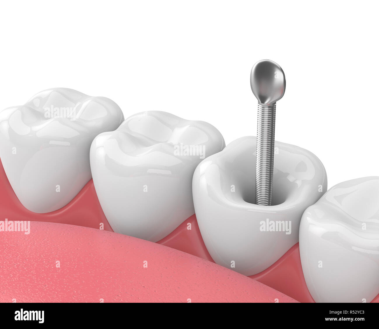 3d render of jaw with teeth and dental metal post over white. Endodontic treatment concept Stock Photo