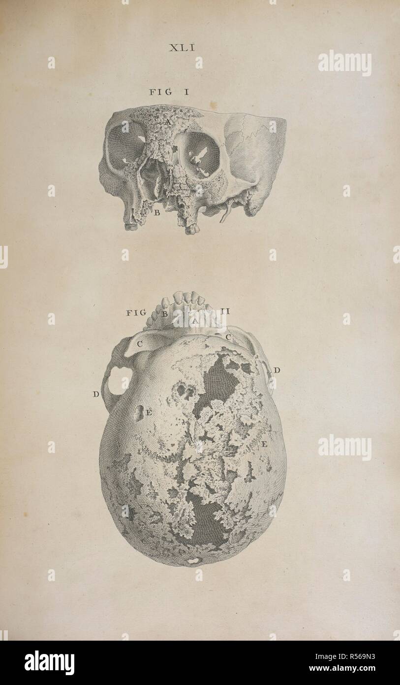 Human skull showing indications of disease. Osteographia, or the Anatomy of the bones. London, 1733. Source: 458.g.1 plate XLI. Author: Cheselden, William. Stock Photo