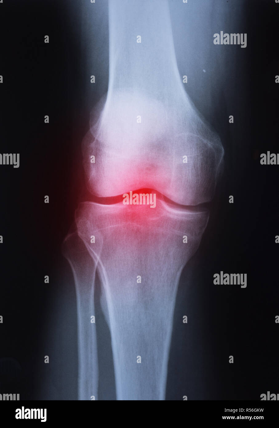 Rheumatoid arthritis x ray knee hires stock photography and images Alamy