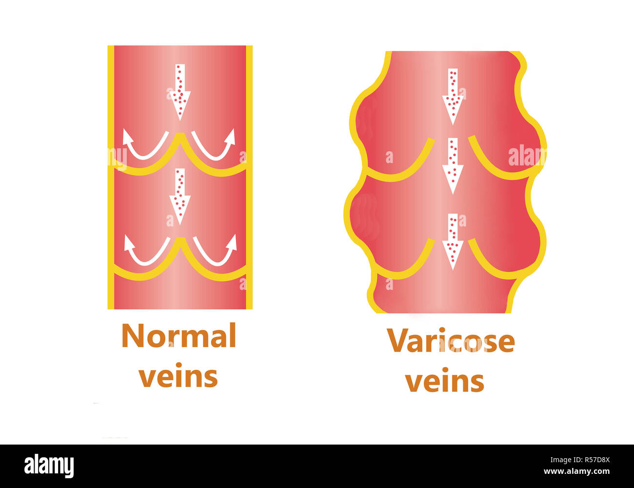 The varicose veins and normal veins Stock Photo