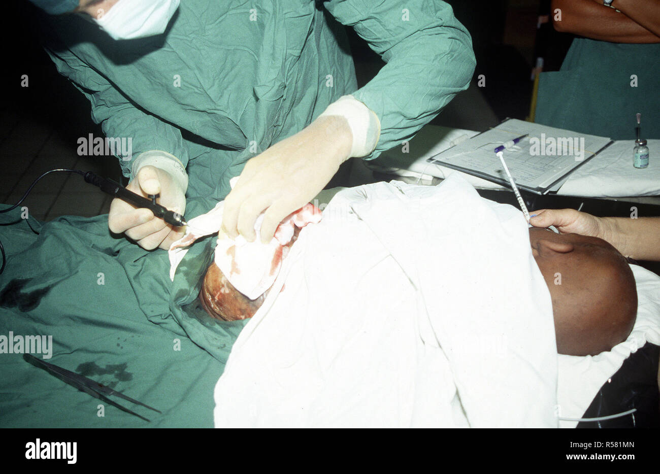 1993 - A doctor performs a skin graph on 2 1/2 year old Ali Salad Roble in the operating room of the Swedish hospital. (Mogadishu Somalia) Stock Photo