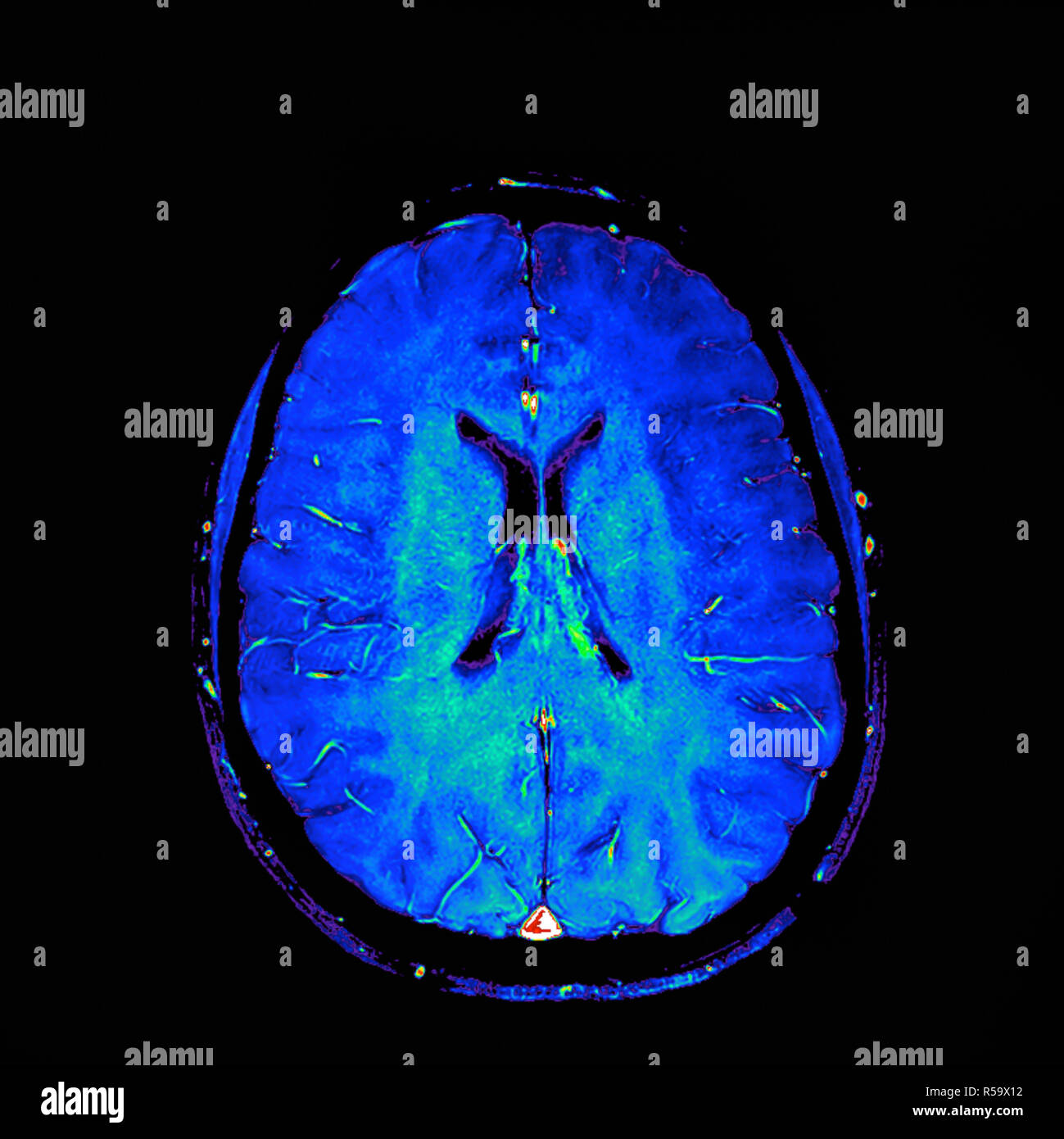 Coloured magnetic resonance imaging (MRI) scan of a sagittal section ...