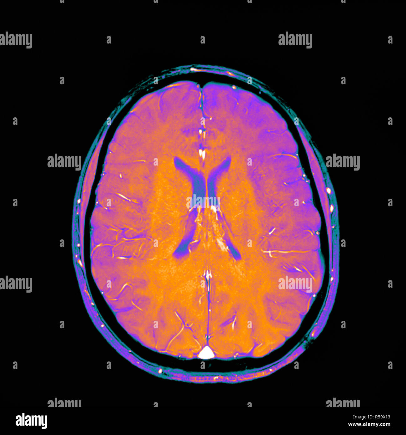 Coloured resonance imaging (MRI) scan of a sagittal section