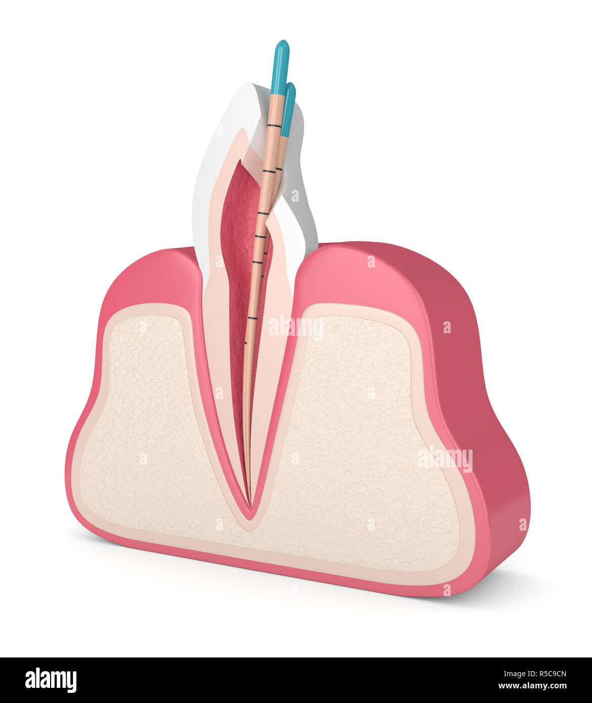 3d render of incisor tooth with gutta percha in gums over white