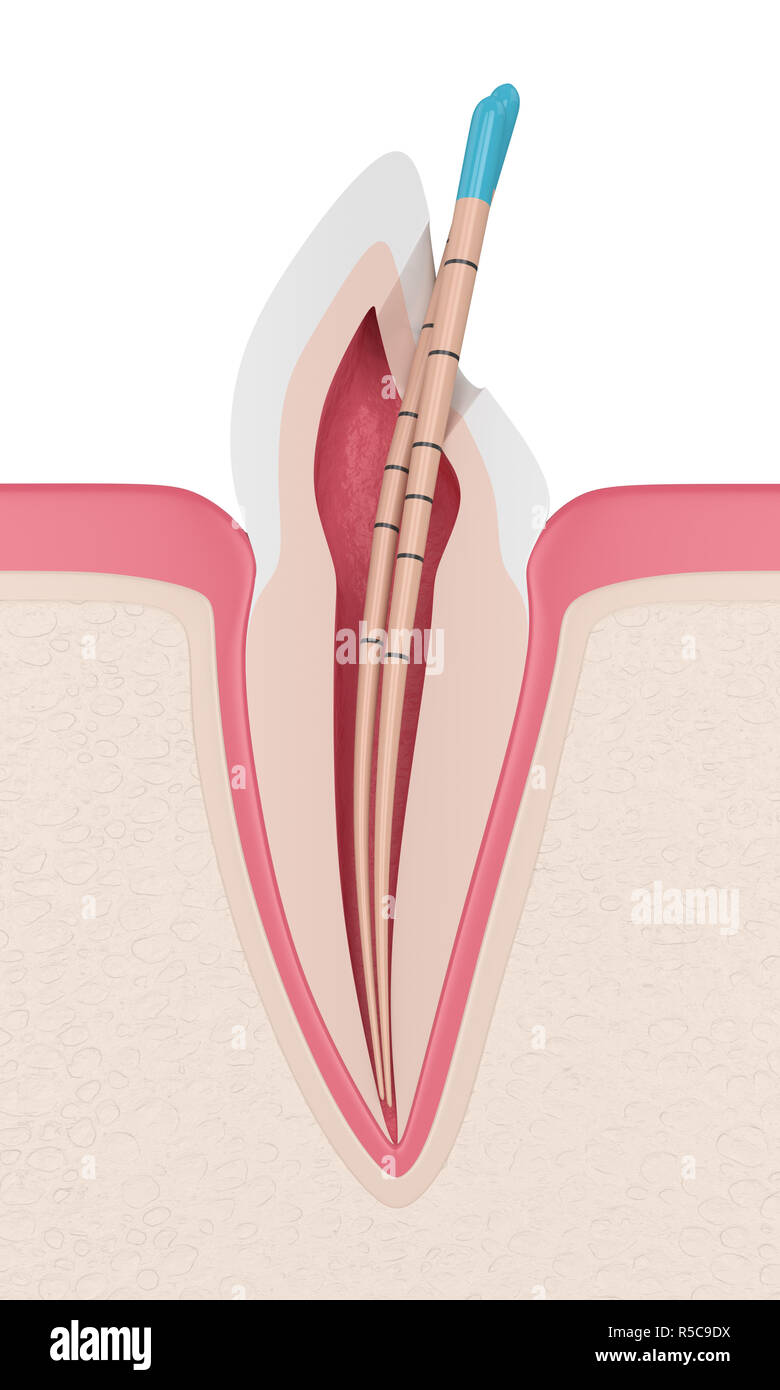 3d render of incisor tooth with gutta percha in gums. Endodontic treatment  concept Stock Photo - Alamy