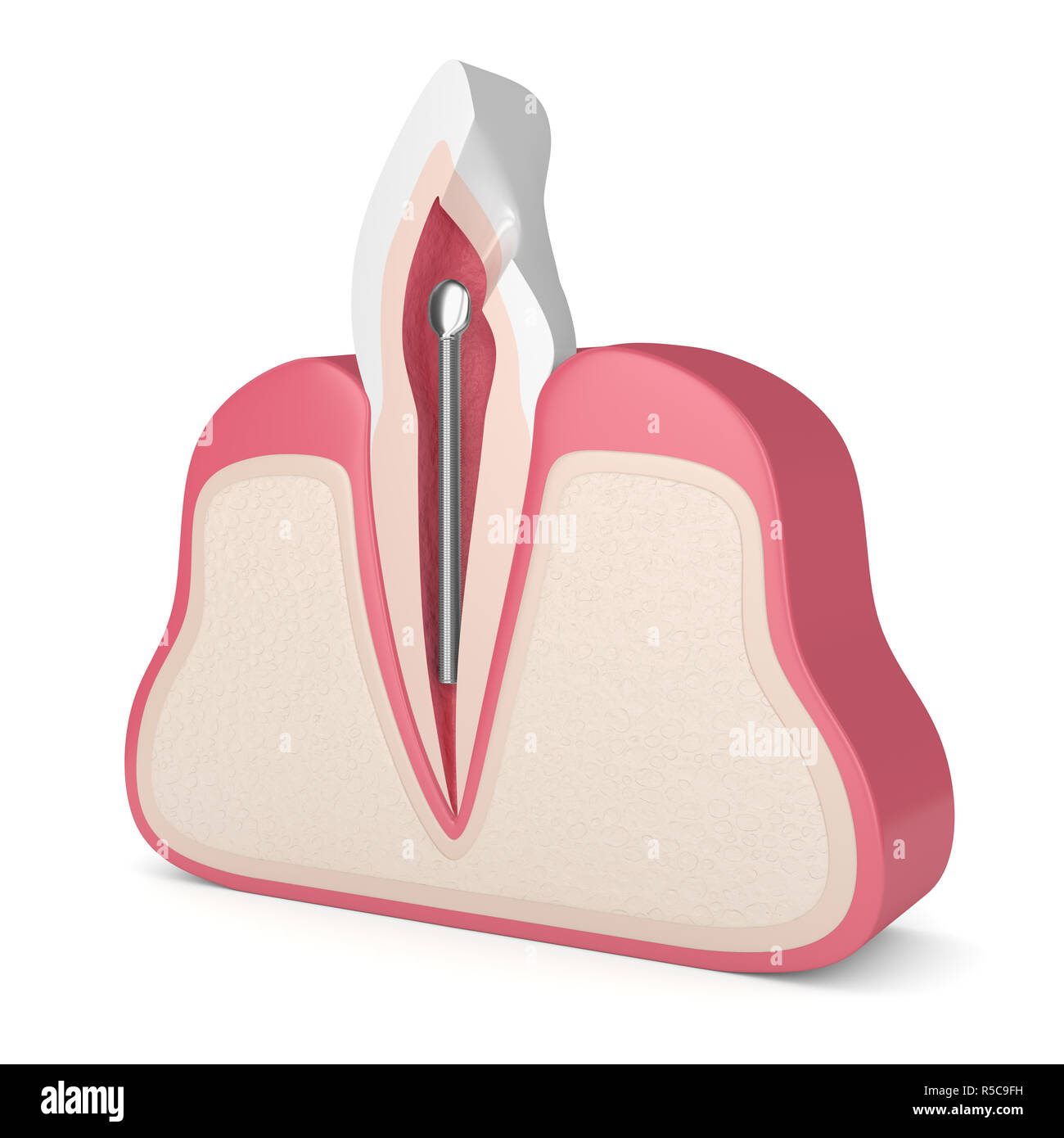 3d render of tooth with dental stainless steel post in gums over white. Endodontic treatment concept Stock Photo