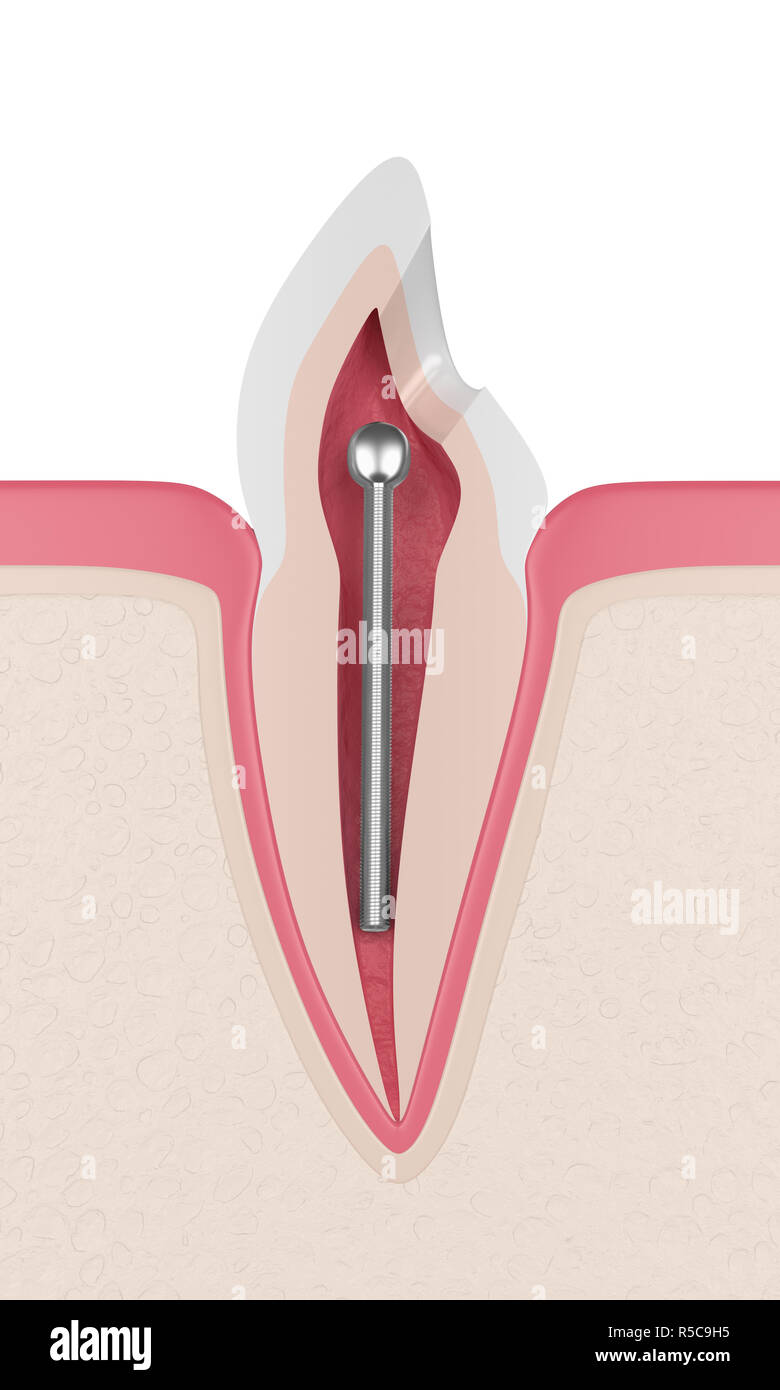 3d render of tooth with dental stainless steel post in gums. Endodontic treatment concept Stock Photo