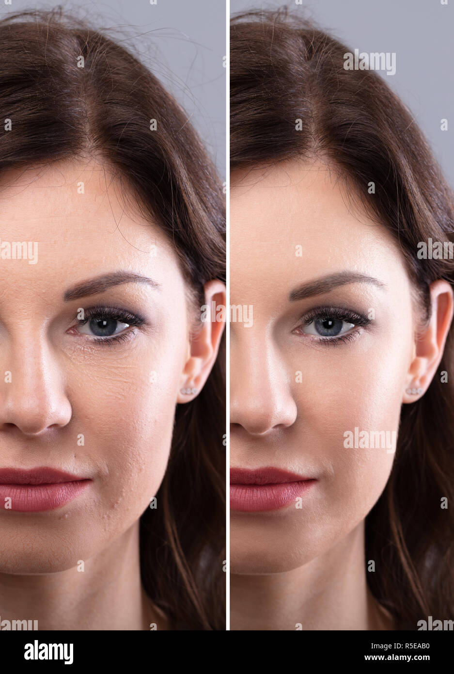 Portrait Of A Young Woman's Face Before And After Cosmetic Procedure Stock Photo