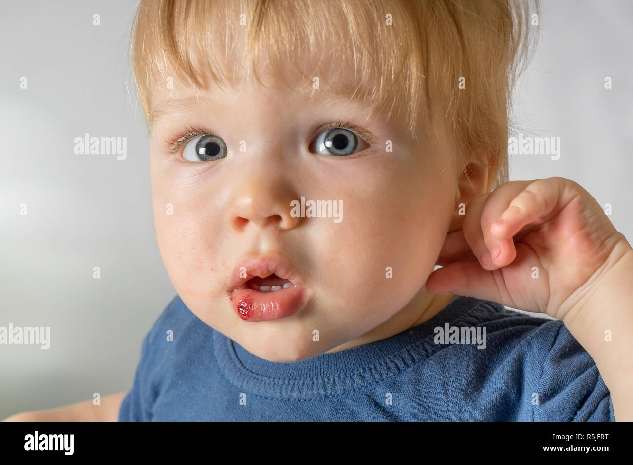 Closeup of baby bruised injured lip after falling. Children traumas