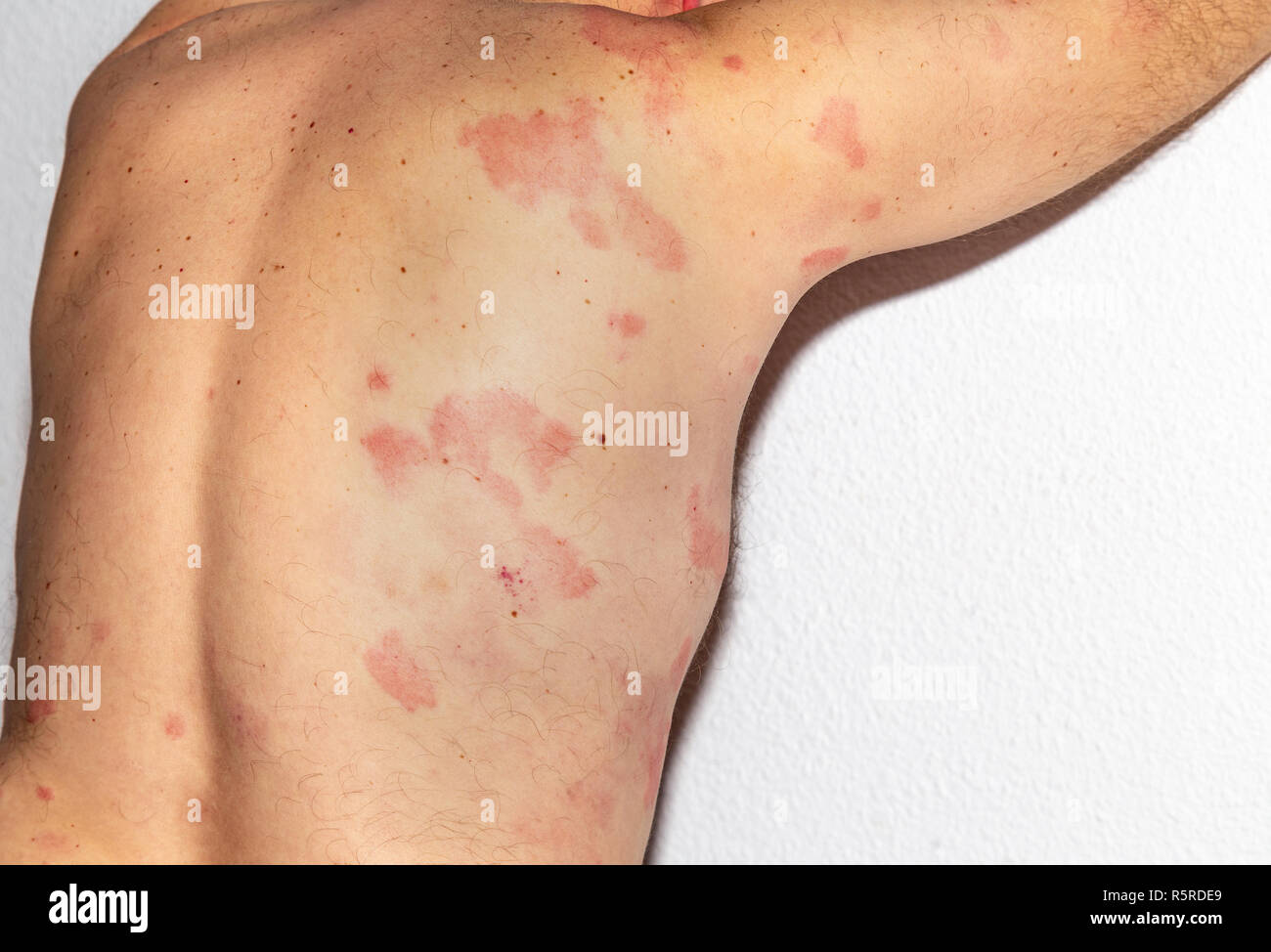 Man with dermatitis problem of rash. Allergy rash. Histamine reaction