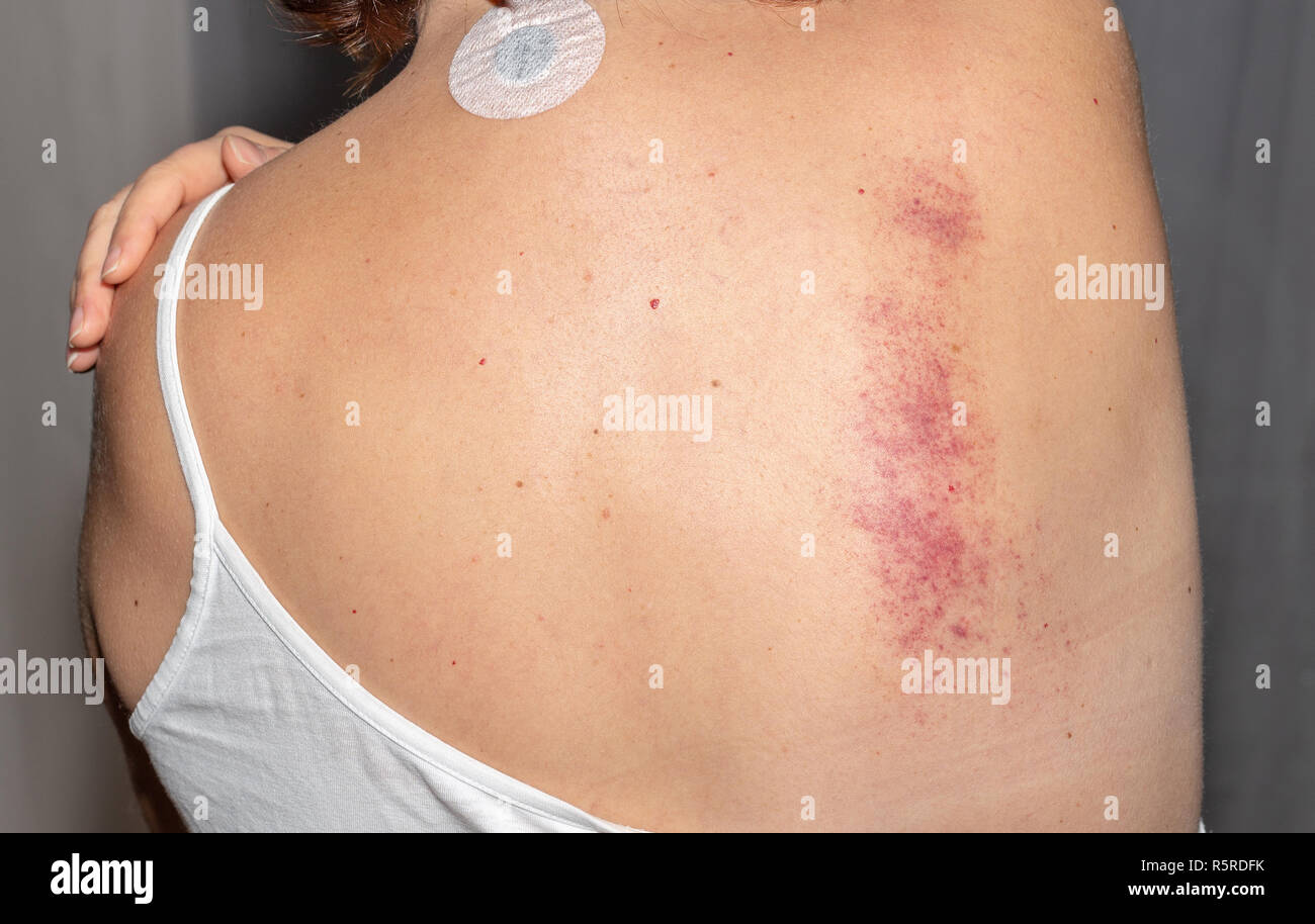 Cupping marks hires stock photography and images Alamy