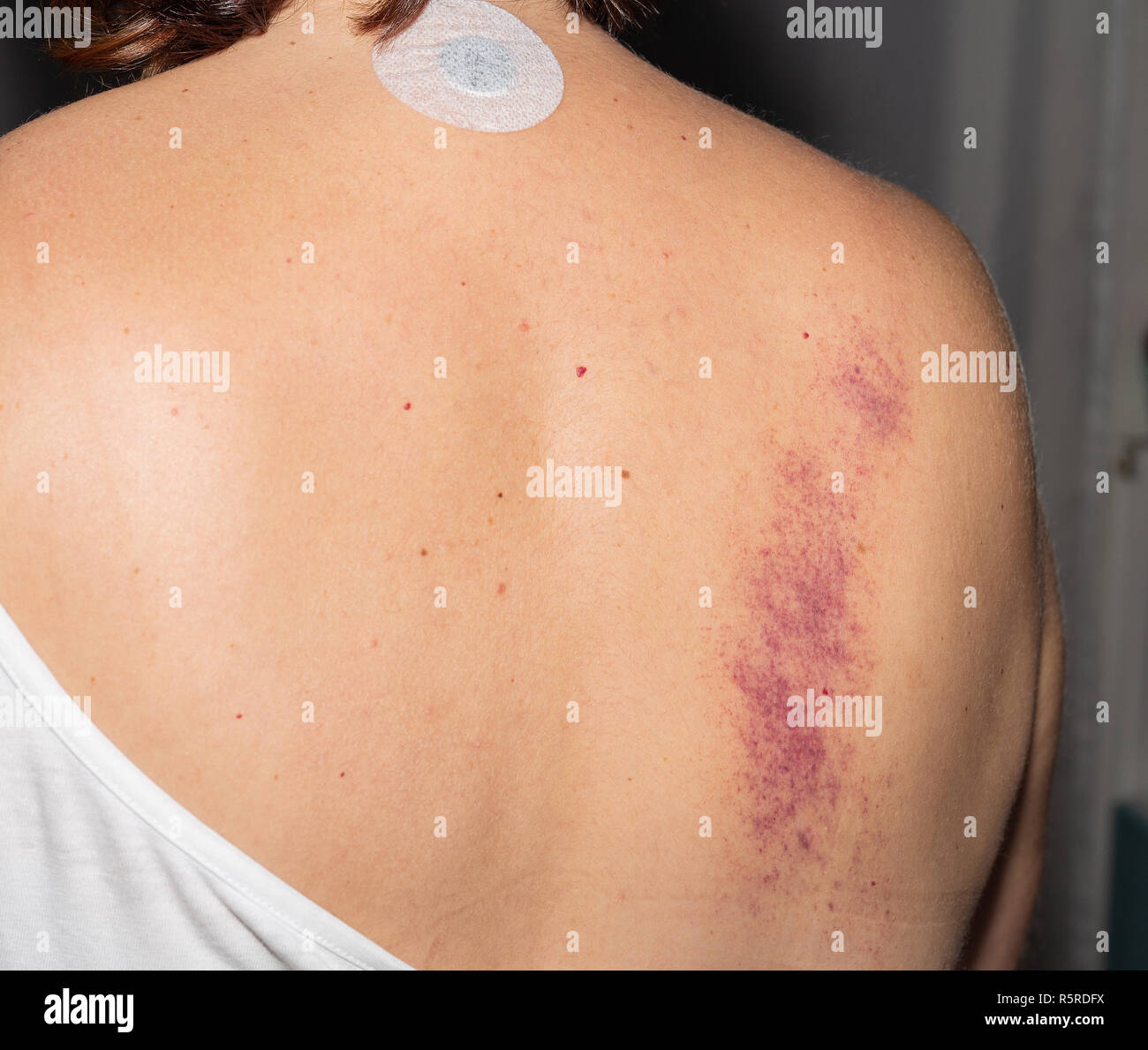 Cupping Massage Stock Photos & Cupping Massage Stock Images Alamy