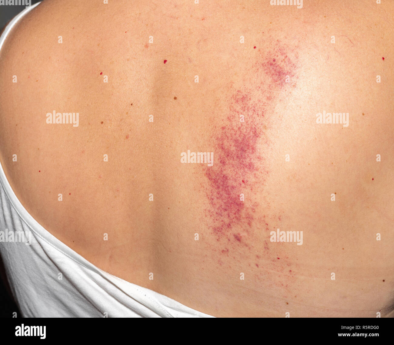 Cupping marks hires stock photography and images Alamy