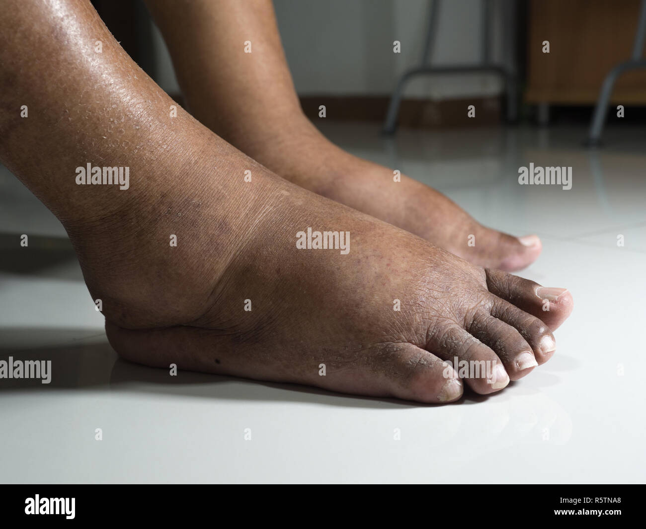 The Feet Of People With Diabetes Dull And Swollen Due To The Toxicity