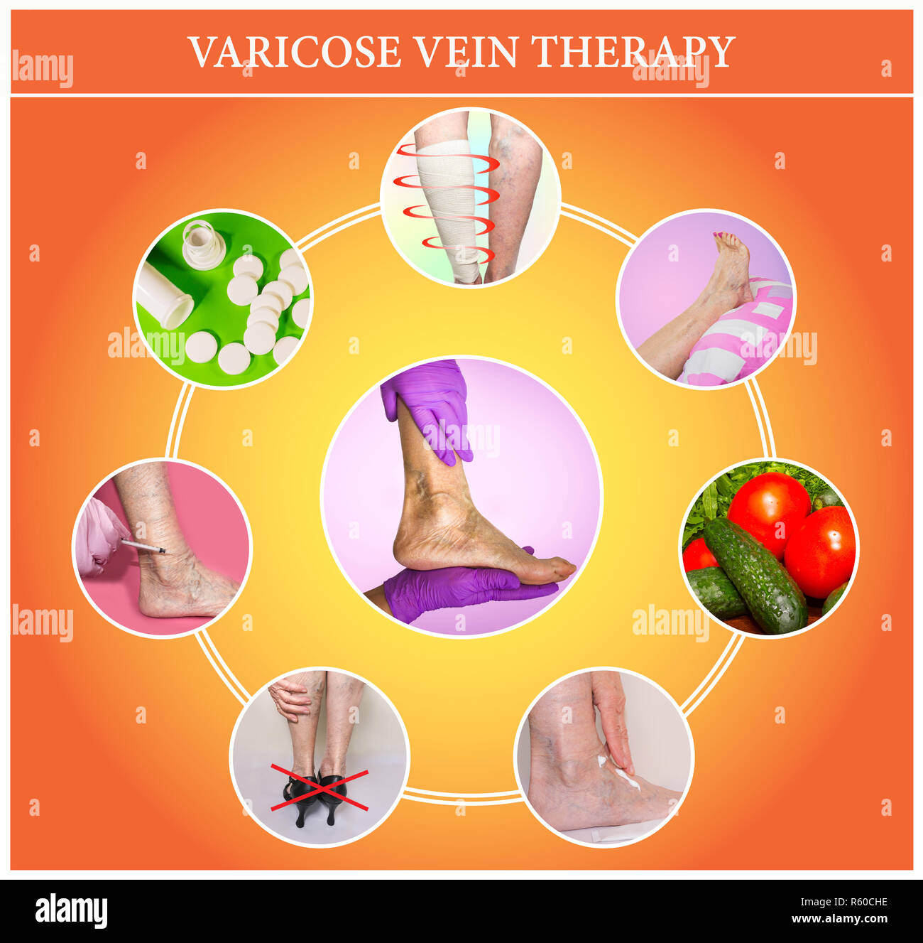 Treatment of varicose veins Stock Photo Alamy