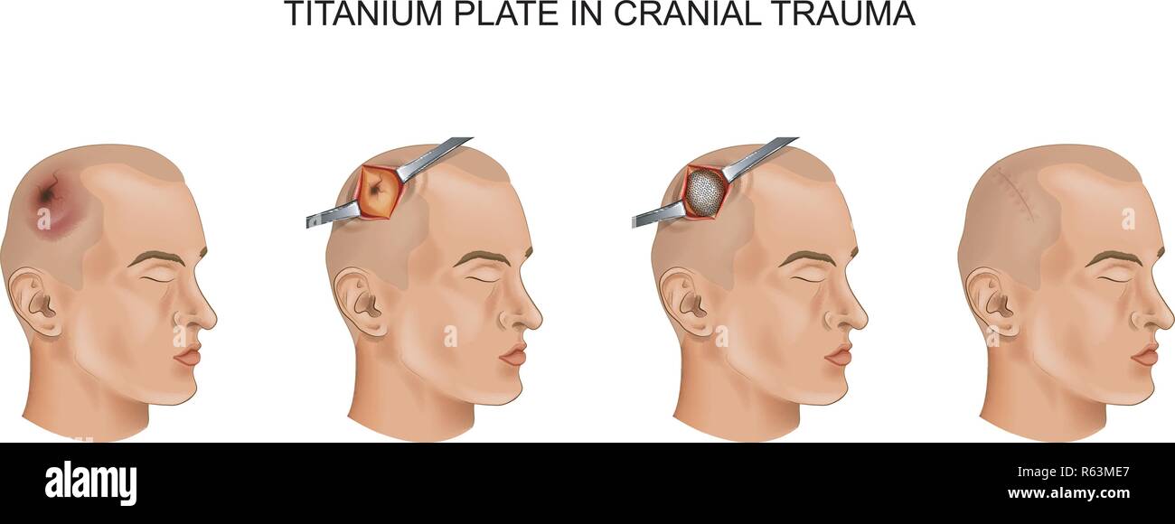 vector illustration of titanium plate in traumatic brain injury Stock Vector