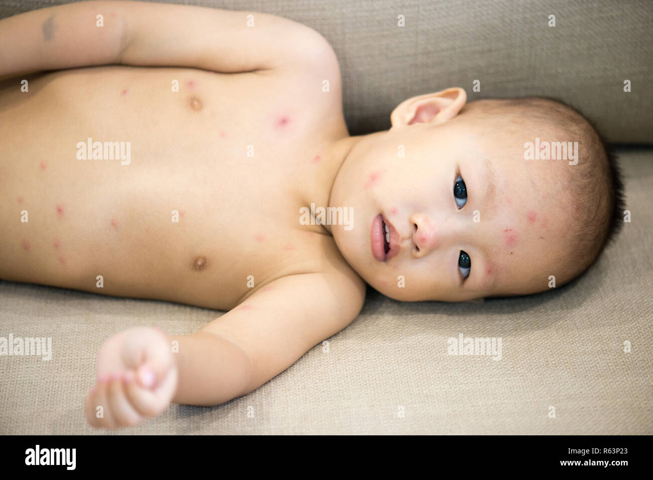 Baby boy with chicken pox lying on sofa Stock Photo