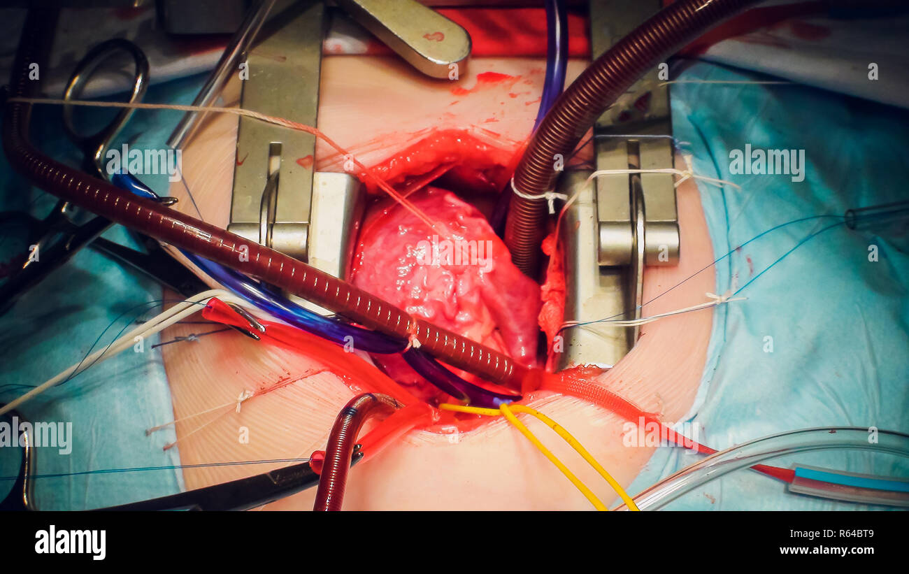 Heart transplant hi-res stock photography and images - Alamy Heart transplant hi-res stock photography and images - Alamy