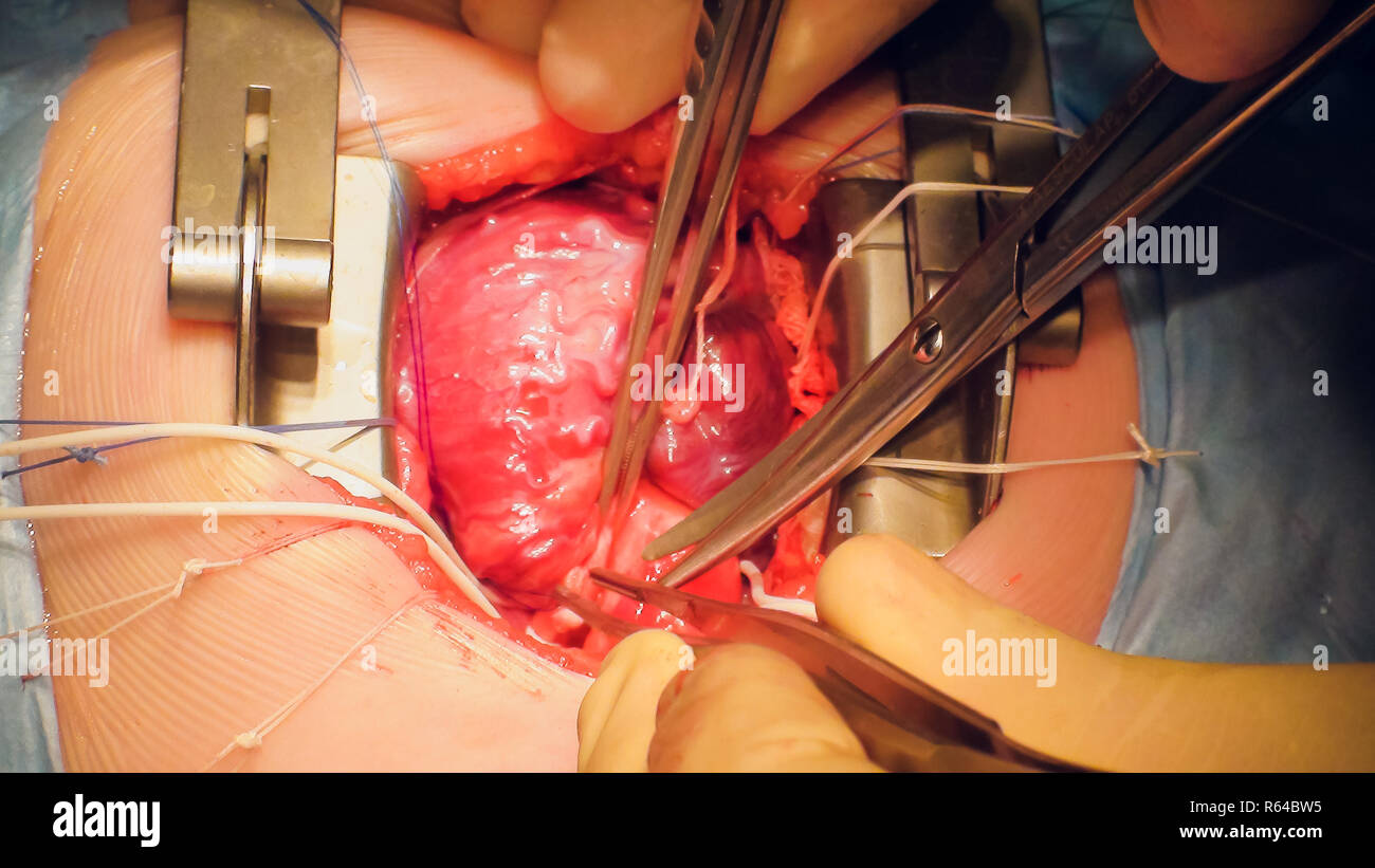 Heart transplant hi-res stock photography and images - Alamy