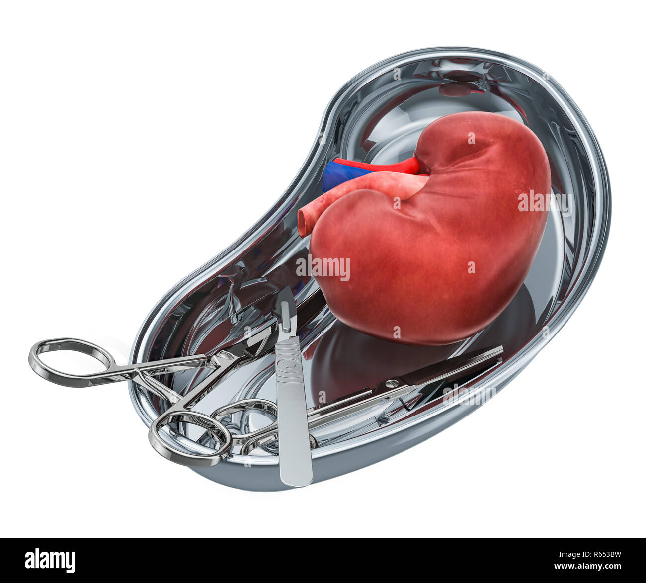 Kidney transplant surgery concept. Donor kidney in metallic tray with