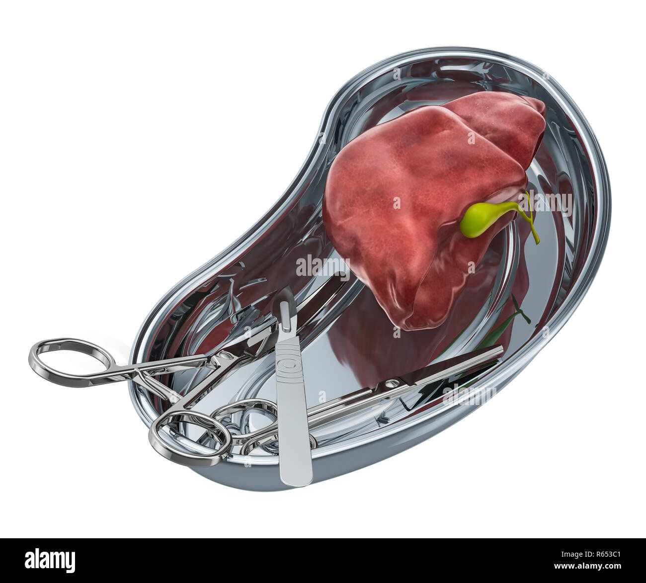 Liver transplant surgery concept. Donor liver in metallic tray with