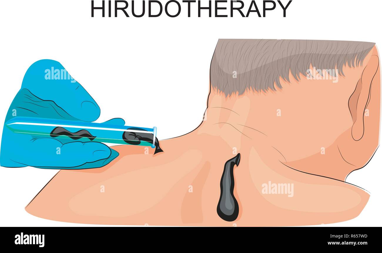 vector illustration of setting leeches on the man's back Stock Vector