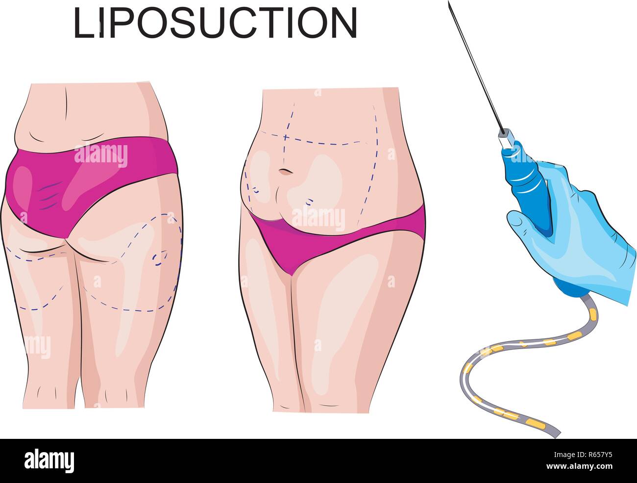 illustration of female body overweight and markings for liposuction Stock Vector