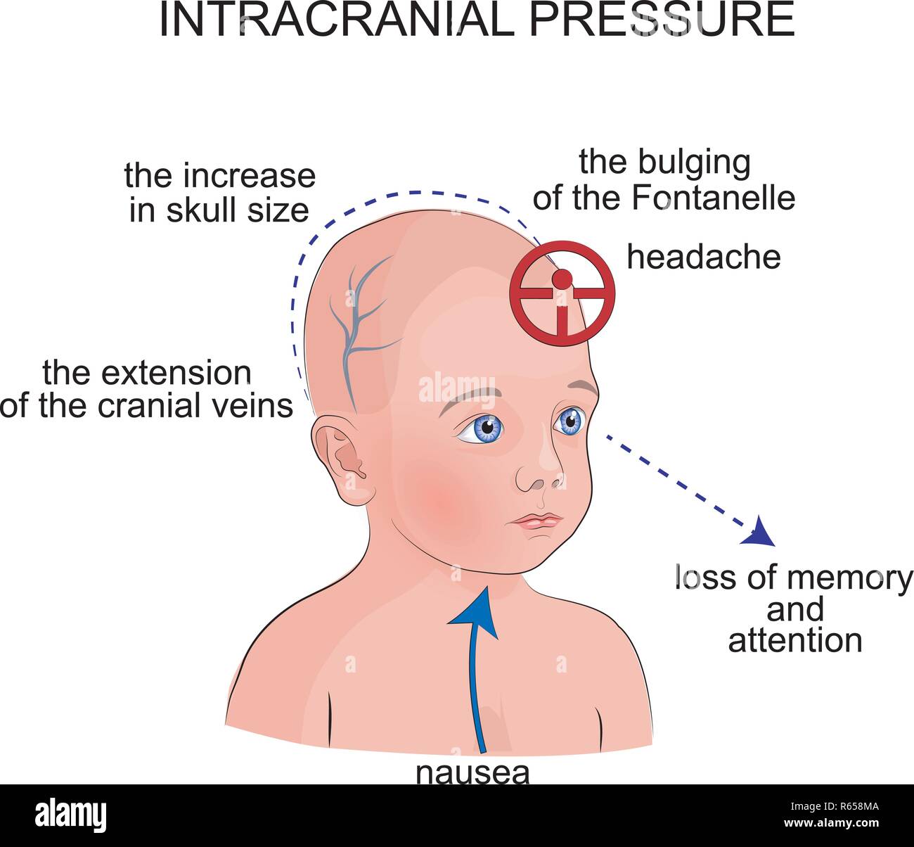 illustration of symptoms of intracranial pressure in children Stock Vector