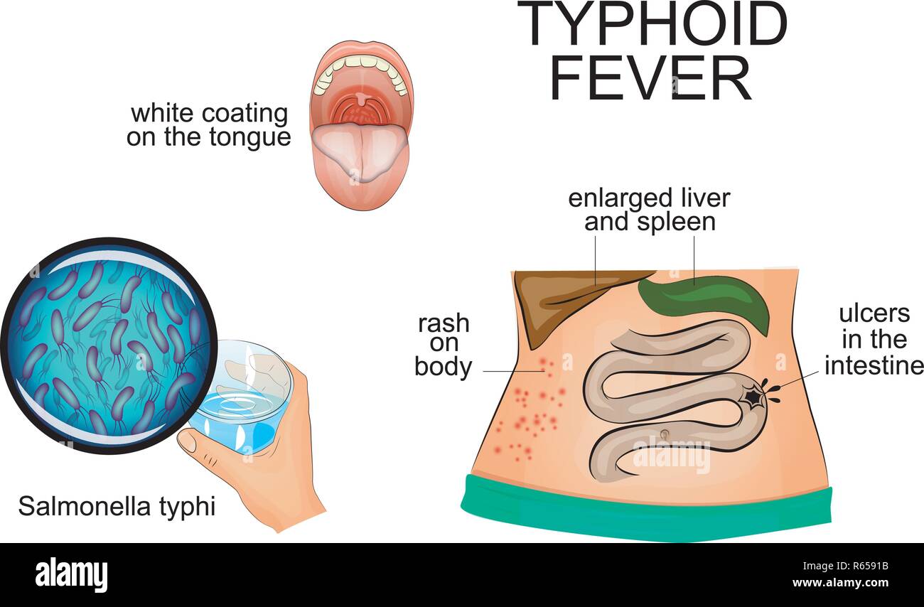 illustration of typhoid fever. infographics. pathogen. symptoms Stock Vector