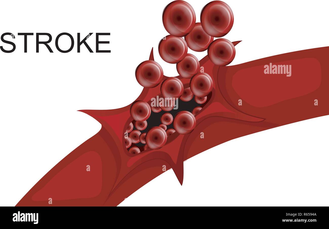 illustration of a rupture of the vessel. hemorrhagic stroke. insult ...